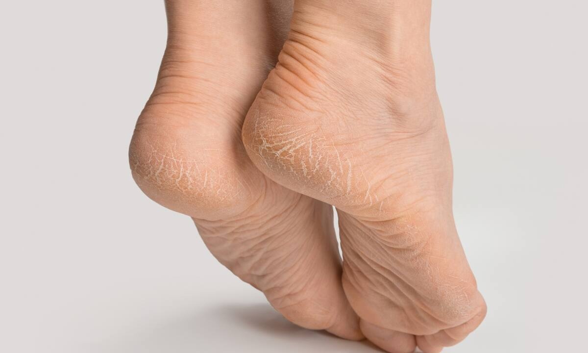 Σκληρύνσεις και κάλοι: Πώς θα απαλλαγείτε (video)