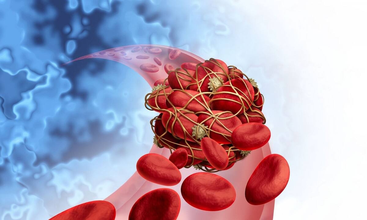 Θρόμβωση: Τα σημάδια που δεν πρέπει να αγνοείτε (video)