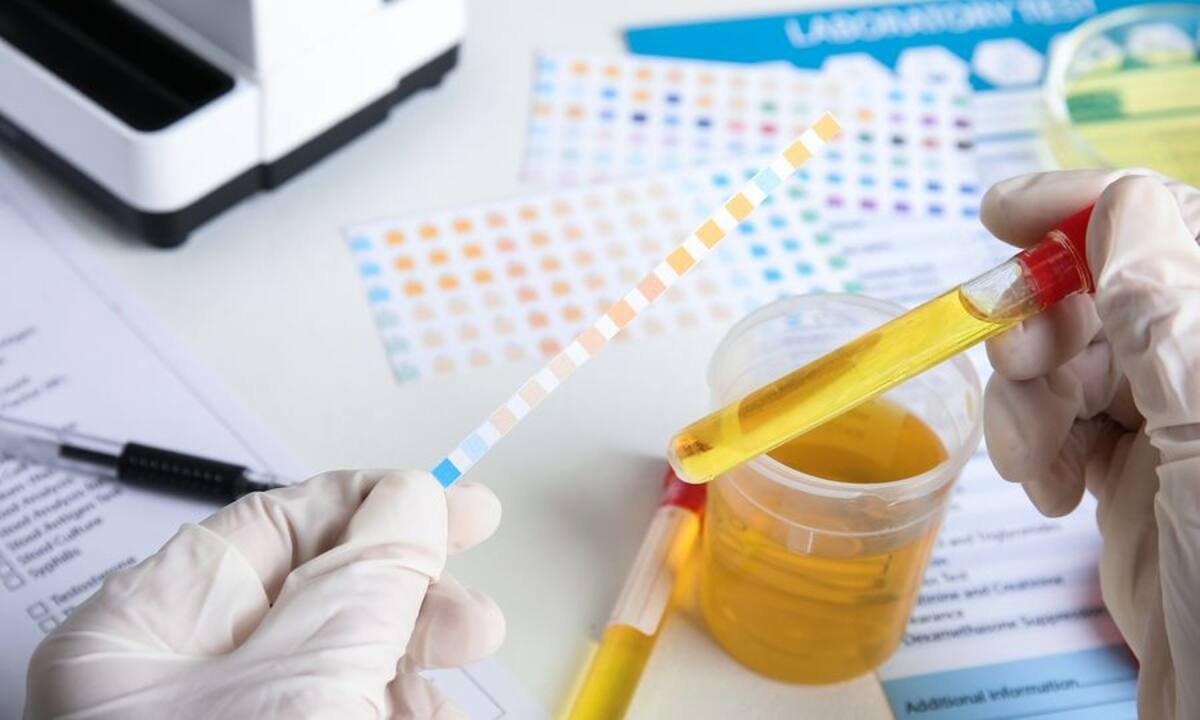 Παθήσεις που επηρεάζουν το χρώμα των ούρων (εικόνες)