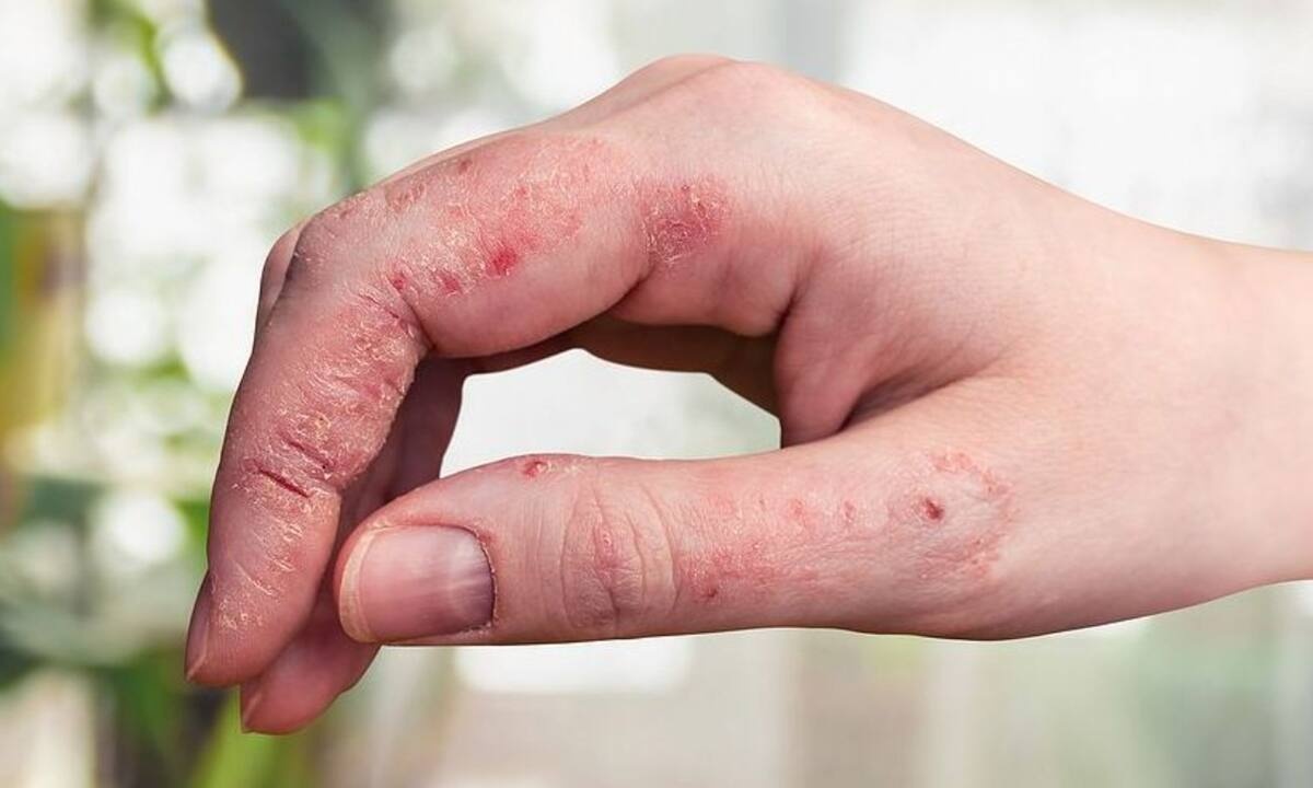 Ψωρίαση: Οι παράγοντες που πυροδοτούν τα συμπτώματα (εικόνες)