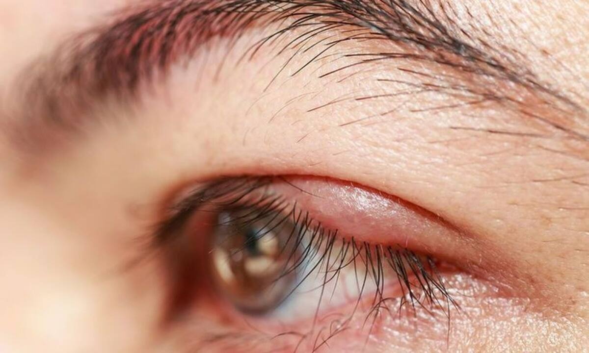 Βλεφαρίτιδα: Το μικρόβιο που την προκαλεί, τα συμπτώματα και η θεραπεία