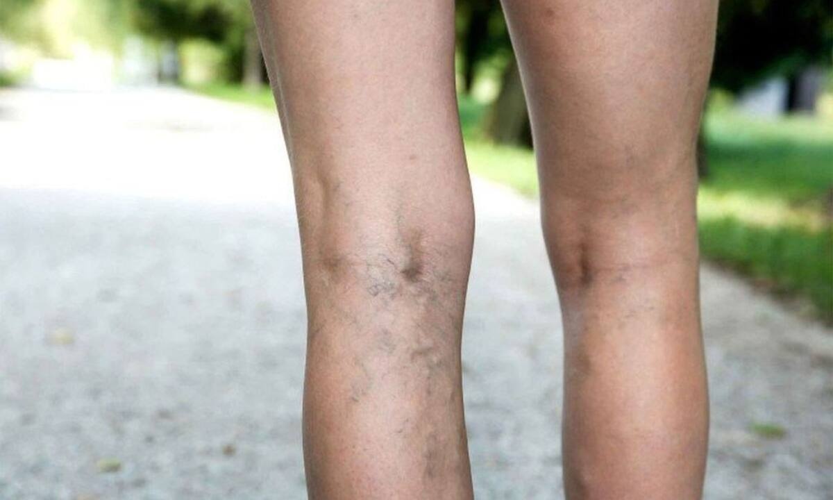 Πείτε «αντίο» στις ευρυαγγείες με αυτή τη φυσική συνταγή (video)