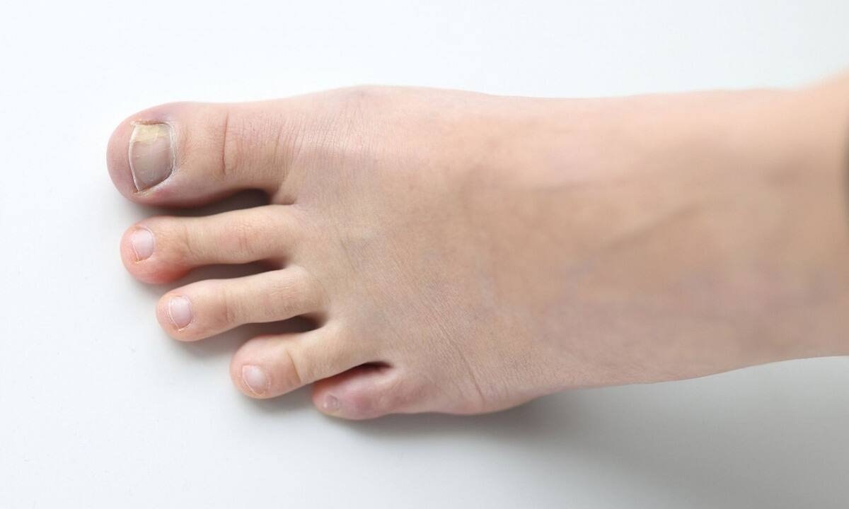 Λευκά σημάδια στα νύχια: Ποιες είναι οι πιθανές αιτίες