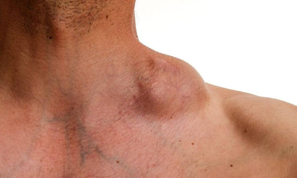 Τι είναι το λέμφωμα Hodgkin