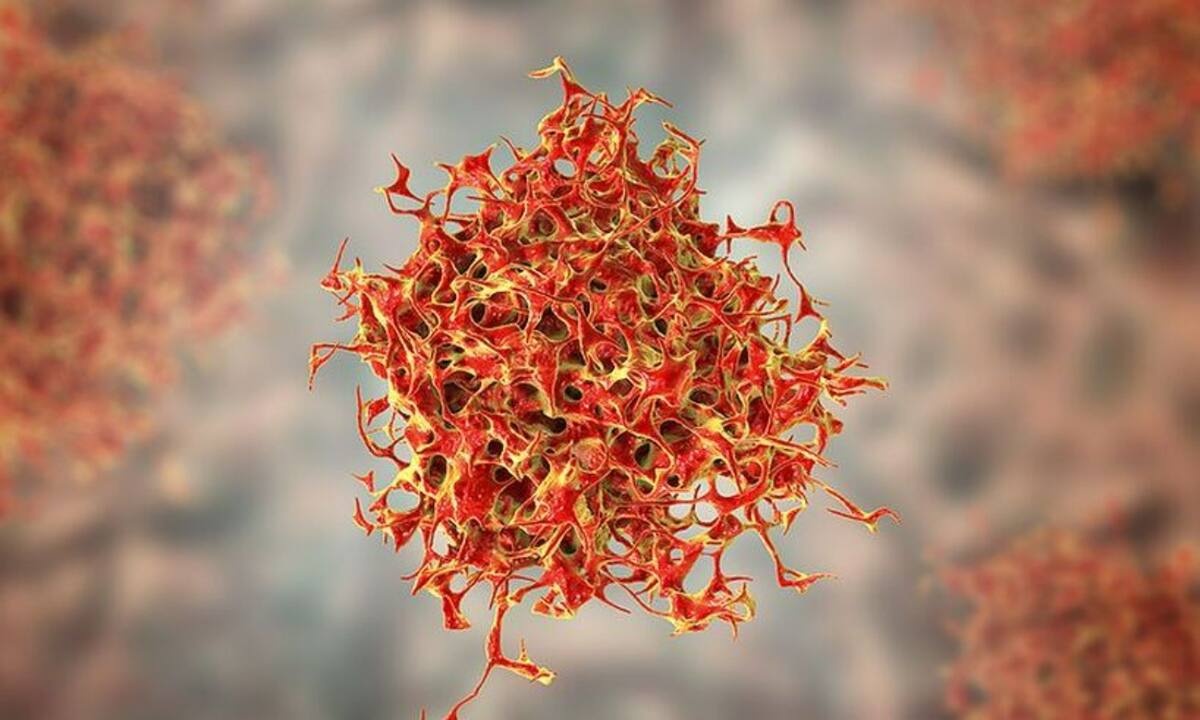 Καρκίνος: Τι μπορεί να δείξει το κάθε στάδιο και τα θεραπευτικά σχήματα