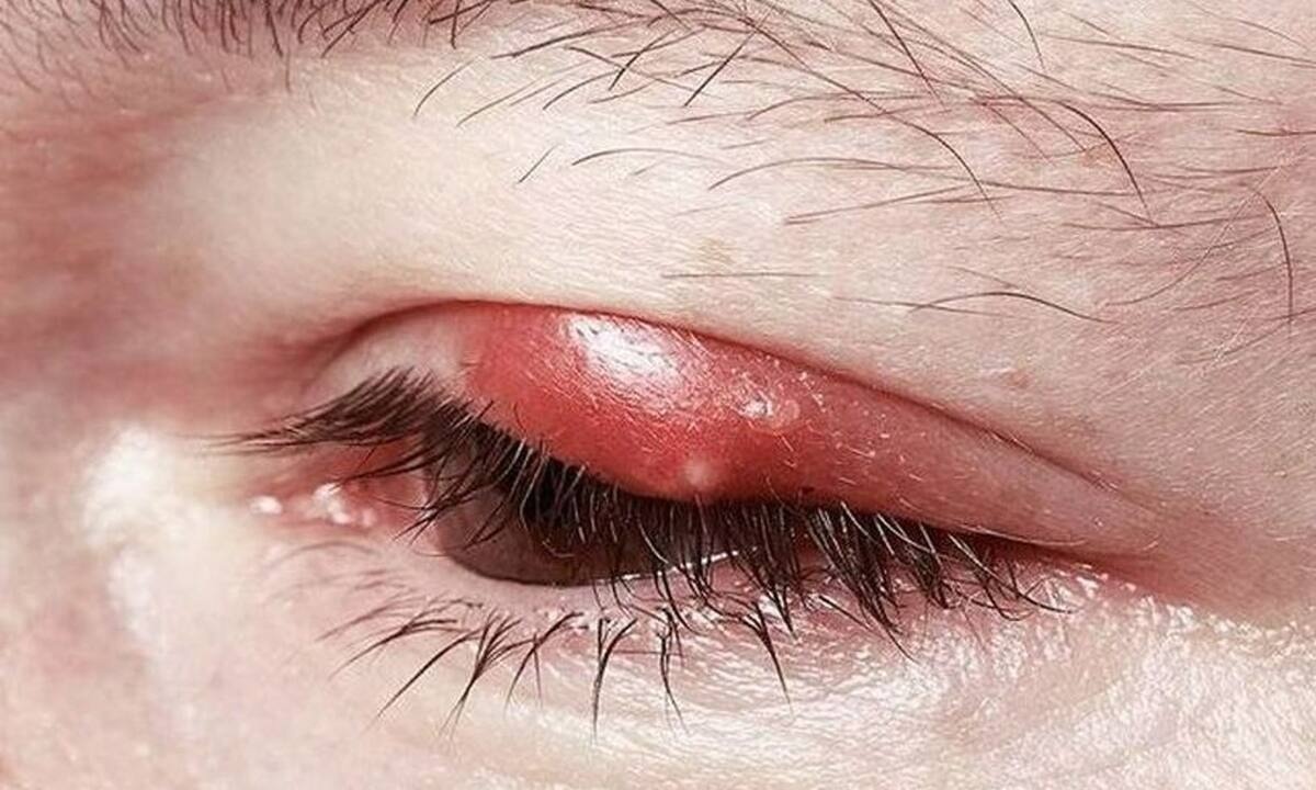 Κριθαράκι στο μάτι; Δείτε τι πρέπει να κάνετε για να θεραπευτεί το δυνατόν γρηγορότερα