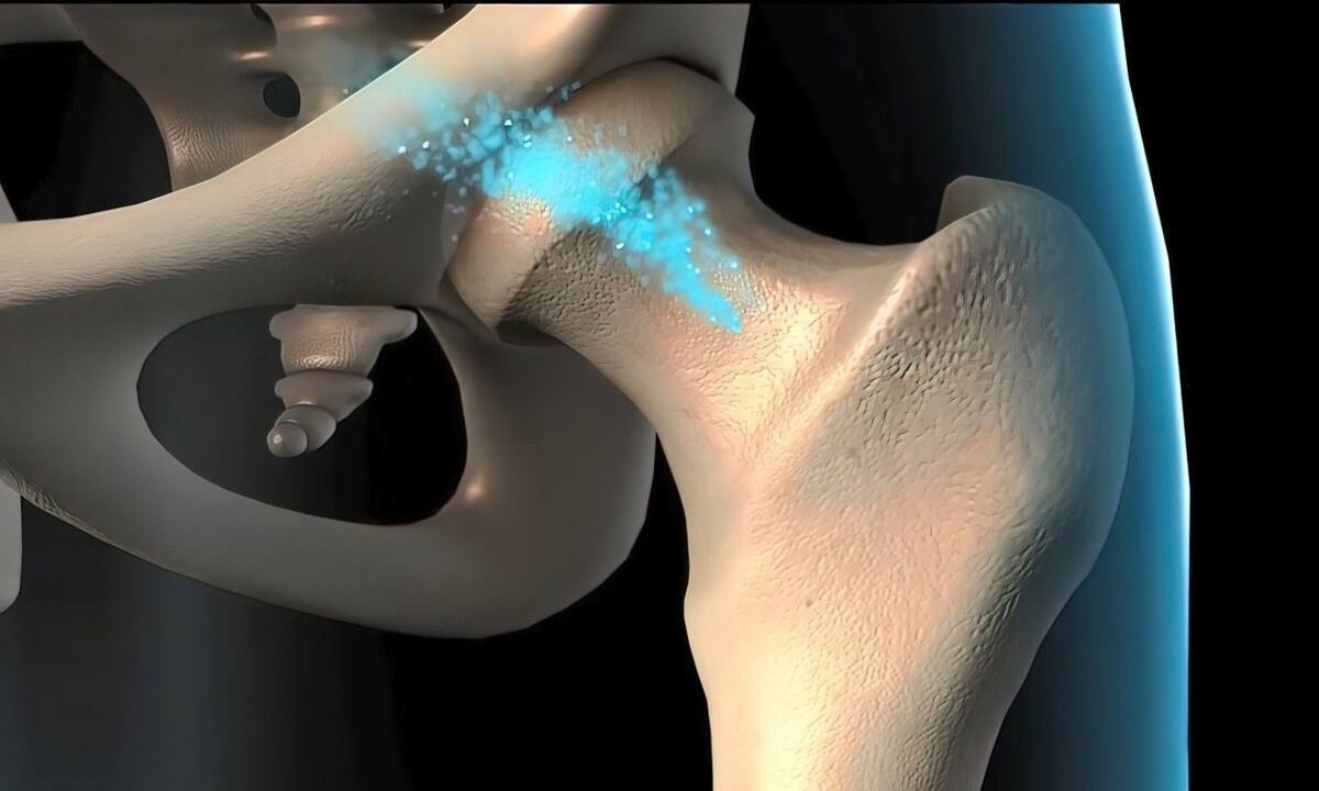 Το φρούτο που προλαμβάνει την οστεοπόρωση