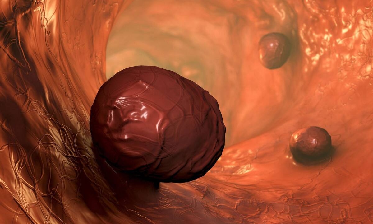 Πολύποδες παχέος εντέρου: Με ποια συμπτώματα εκδηλώνονται