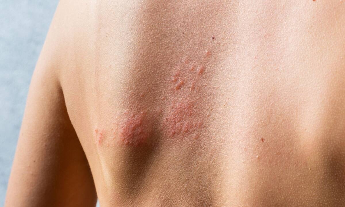 Ιός έρπητα ζωστήρα: Πώς συνδέεται με τον κίνδυνο εγκεφαλικού