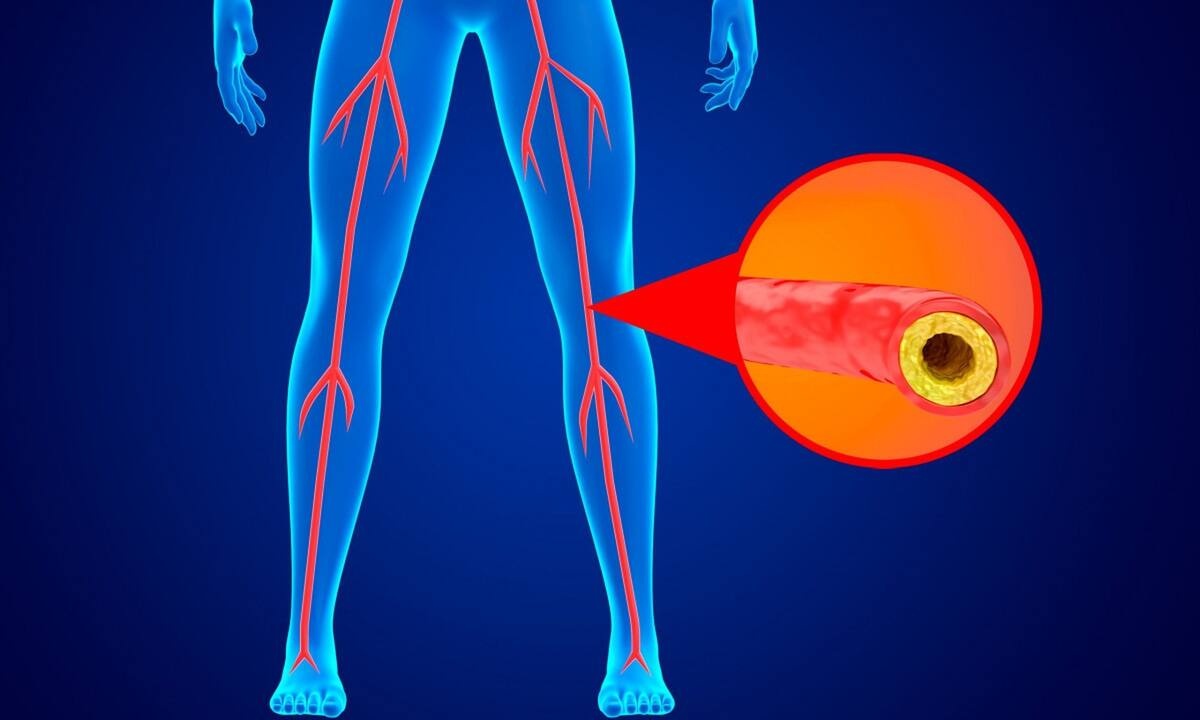 Περιφερική αρτηριακή νόσος: Η επέμβαση που σώζει τα άκρα