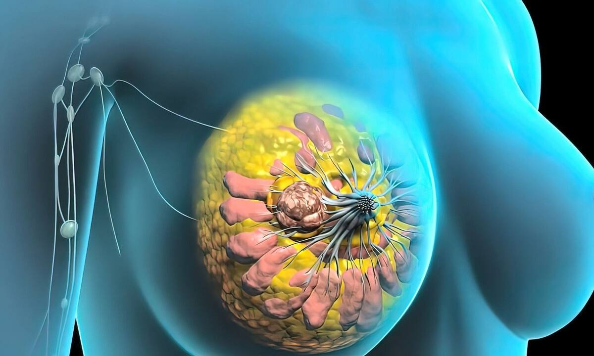 Το συμπλήρωμα που αυξάνει τον κίνδυνο καρκίνου και μεταστάσεων