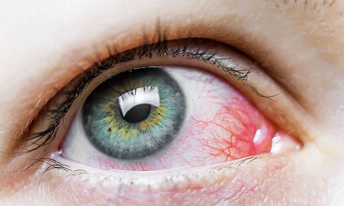 Επιπεφυκίτιδα: Τα είδη της και πώς θα την αντιμετωπίσετε