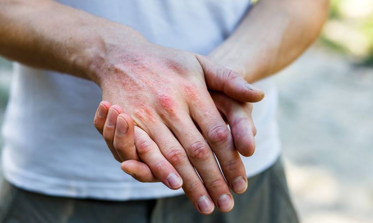 Ατοπική δερματίτιδα: Ποια η σχέση της με τις ημικρανίες