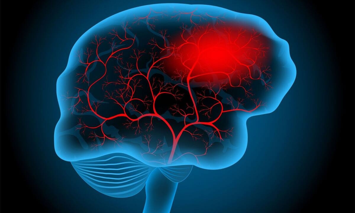 Εγκεφαλικό: Οι παράγοντες που αυξάνουν τον κίνδυνο