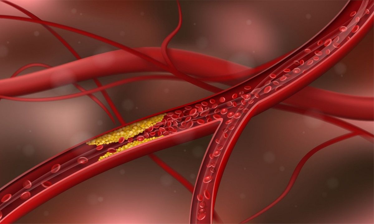 Αθηροσκλήρωση: Πόσο αυξάνει τον κίνδυνο ο κακός ύπνος