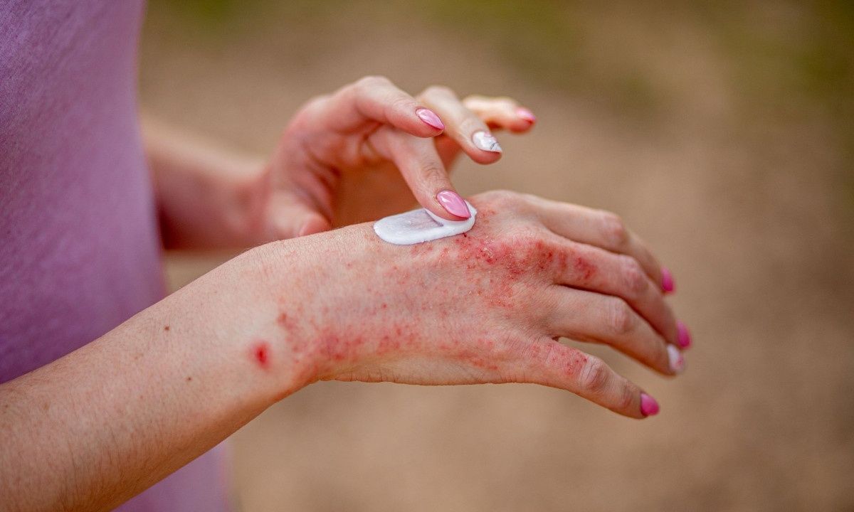 Ξηροδερμία ή έκζεμα; Πώς θα τα ξεχωρίσετε