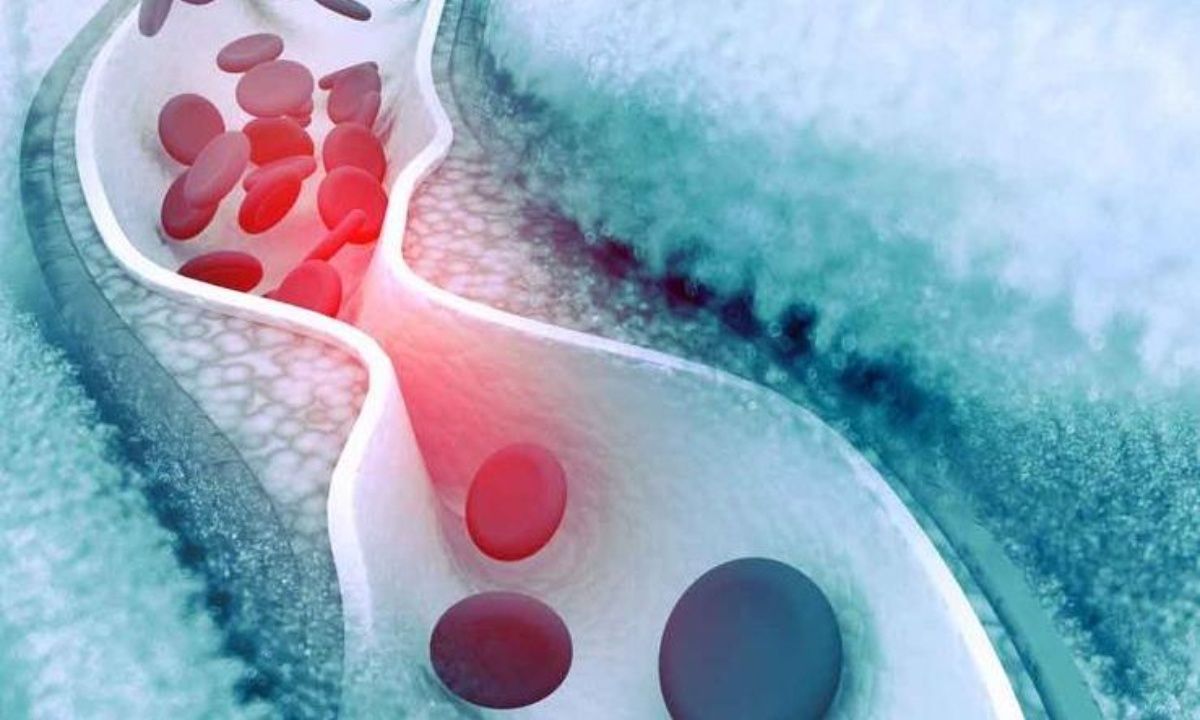 Κακή χοληστερόλη: Ο ιδανικός συνδυασμός για να τη μειώσετε