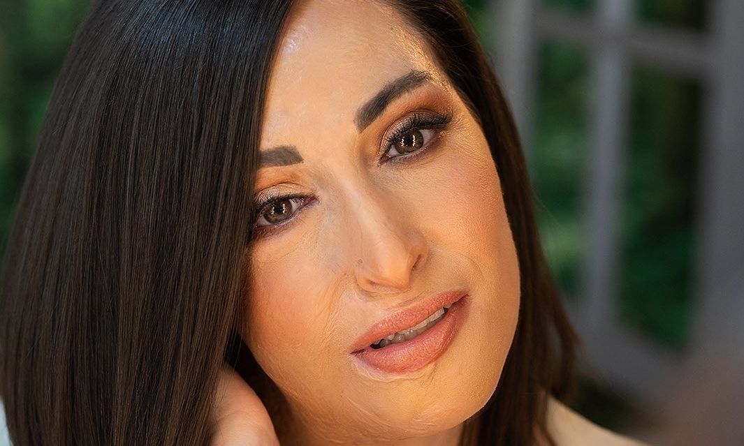 Ιωάννα Παλιοσπύρου: 3 χρόνια από την επίθεση με βιτριόλι - «Ευτυχία όταν η επέτειος γίνεται γιορτή»