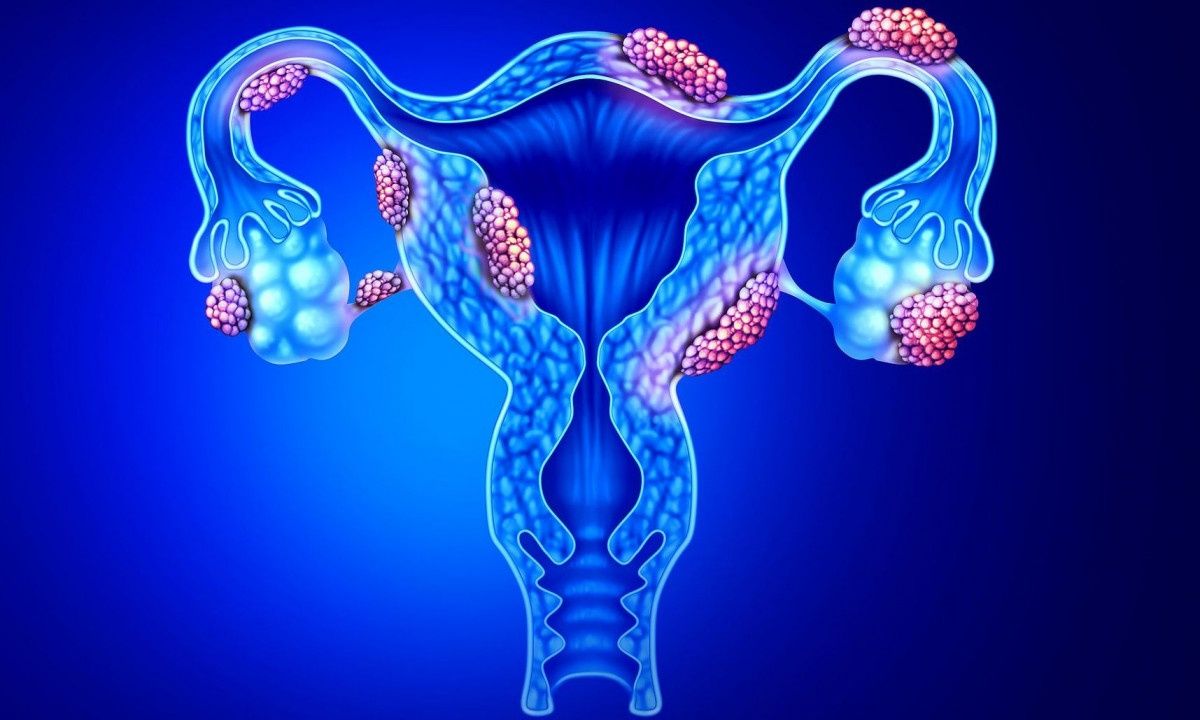 Ενδομητρίωση: Τα συμπτώματα μιας από τις κύριες αιτίες υπογονιμότητας