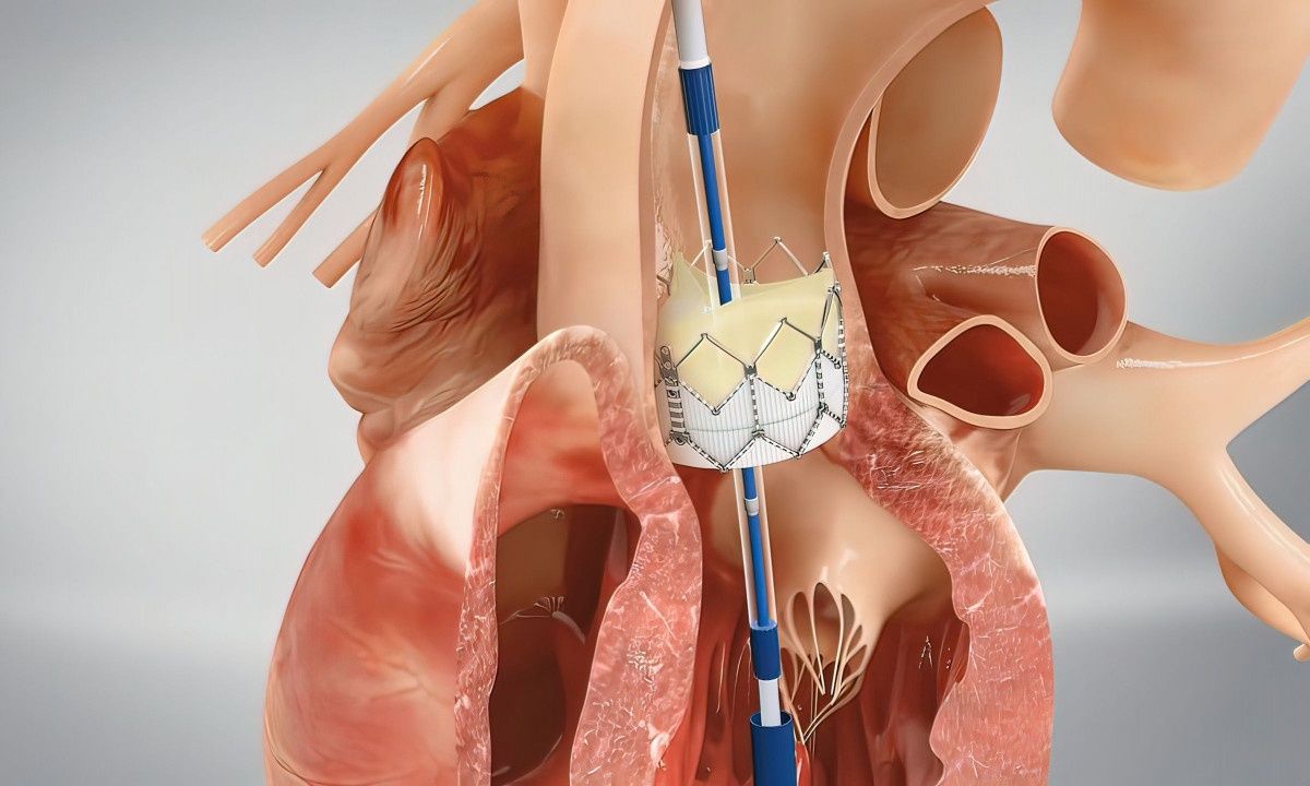 Ανεύρυσμα: Τα συμπτώματα και οι 4 παράγοντες που «μαρτυρούν» ρήξη