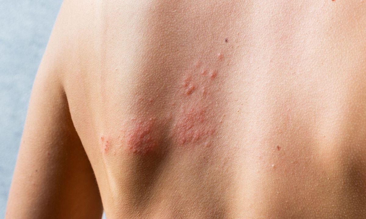 Ιός έρπητα ζωστήρα: Πώς συνδέεται με τον κίνδυνο εγκεφαλικού