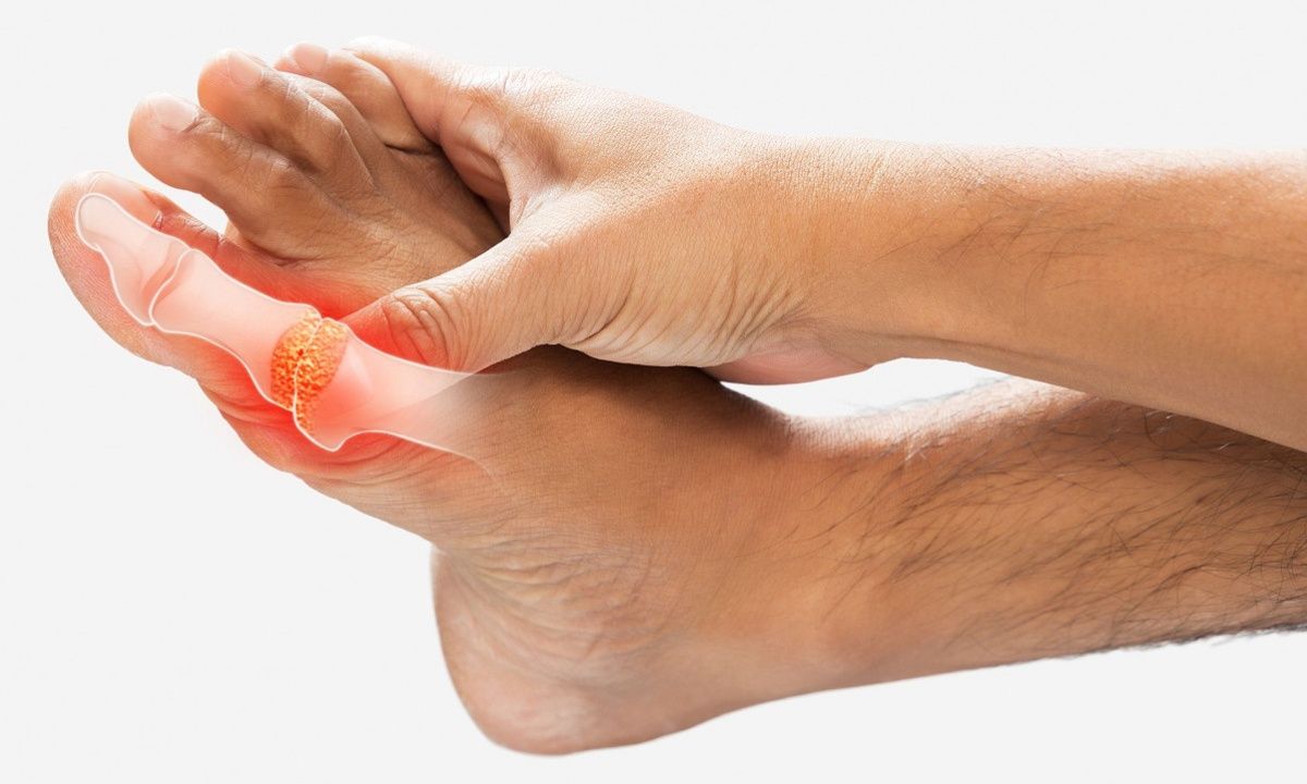 Ανεβασμένο ουρικό οξύ: Με ποια διατροφή θα το αντιμετωπίσετε