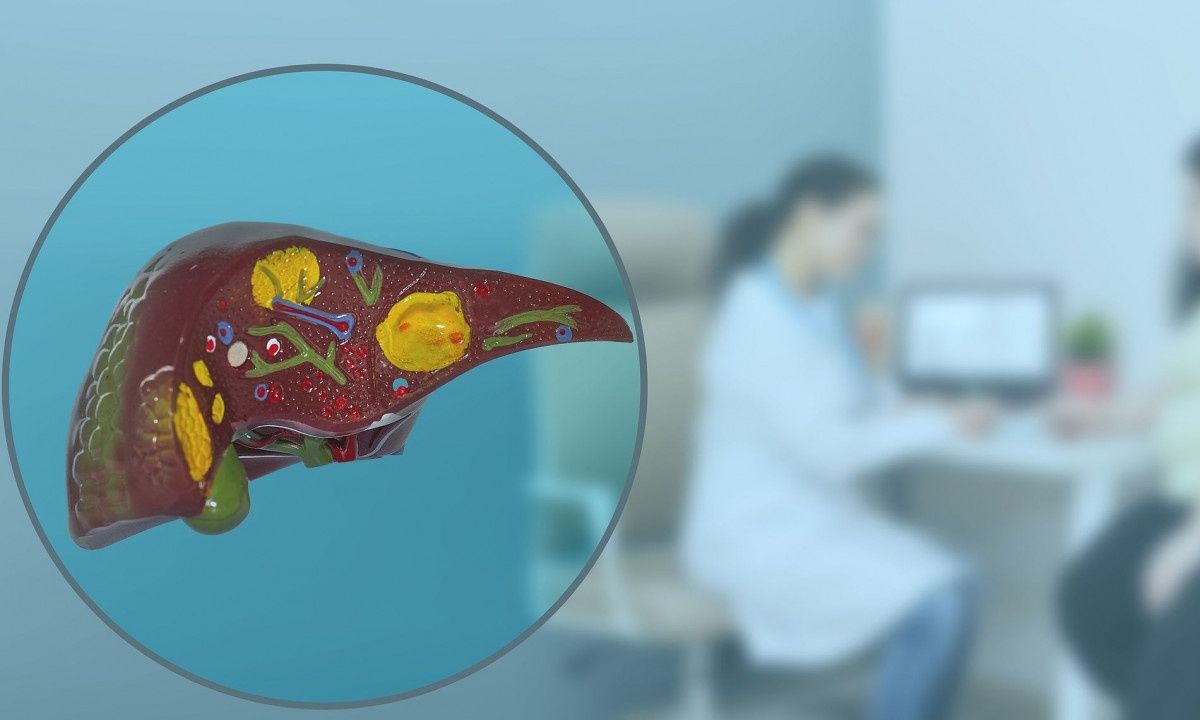 Μη αλκοολική στεατοηπατίτιδα: Η διατροφή για το λίπος στο συκώτι