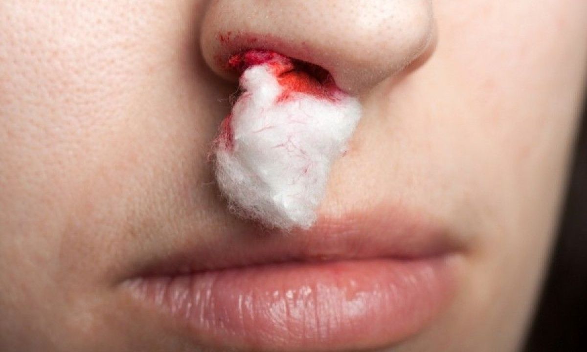Ρινορραγία: Τι πρέπει να κάνετε αν σας συμβεί