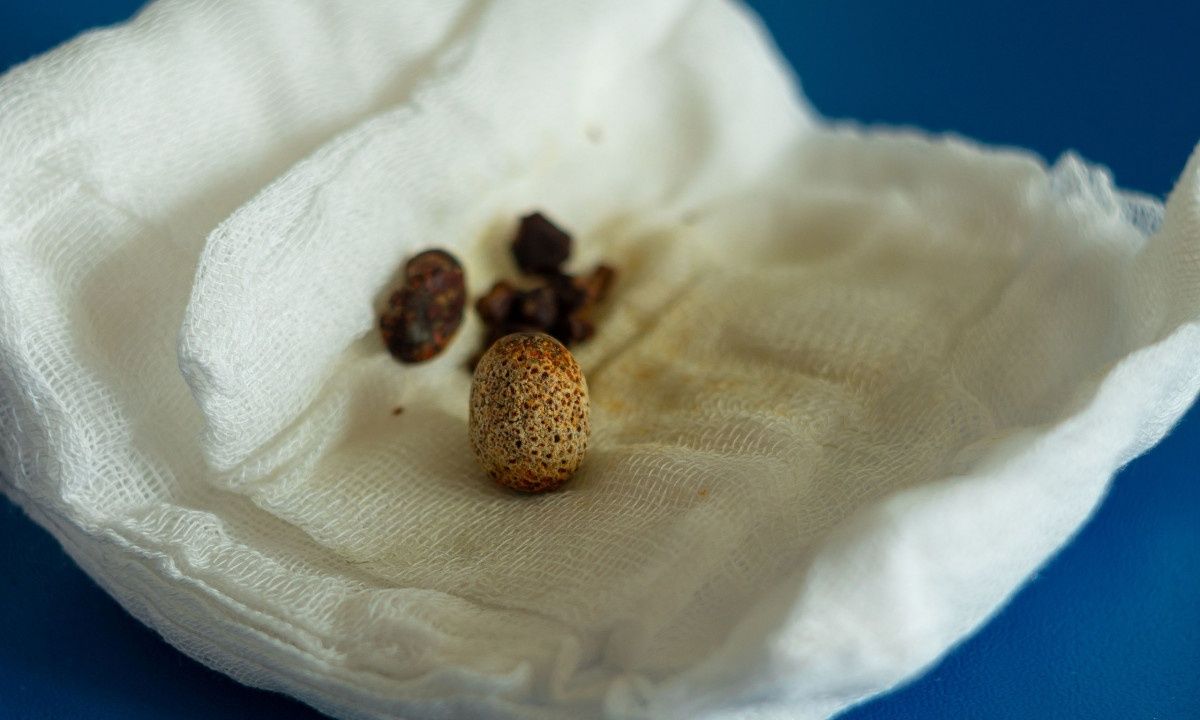 Ποιοι κινδυνεύουν να αναπτύξουν πέτρες στη χολή