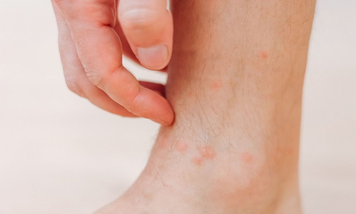 Πού οφείλεται η φαγούρα του εκζέματος