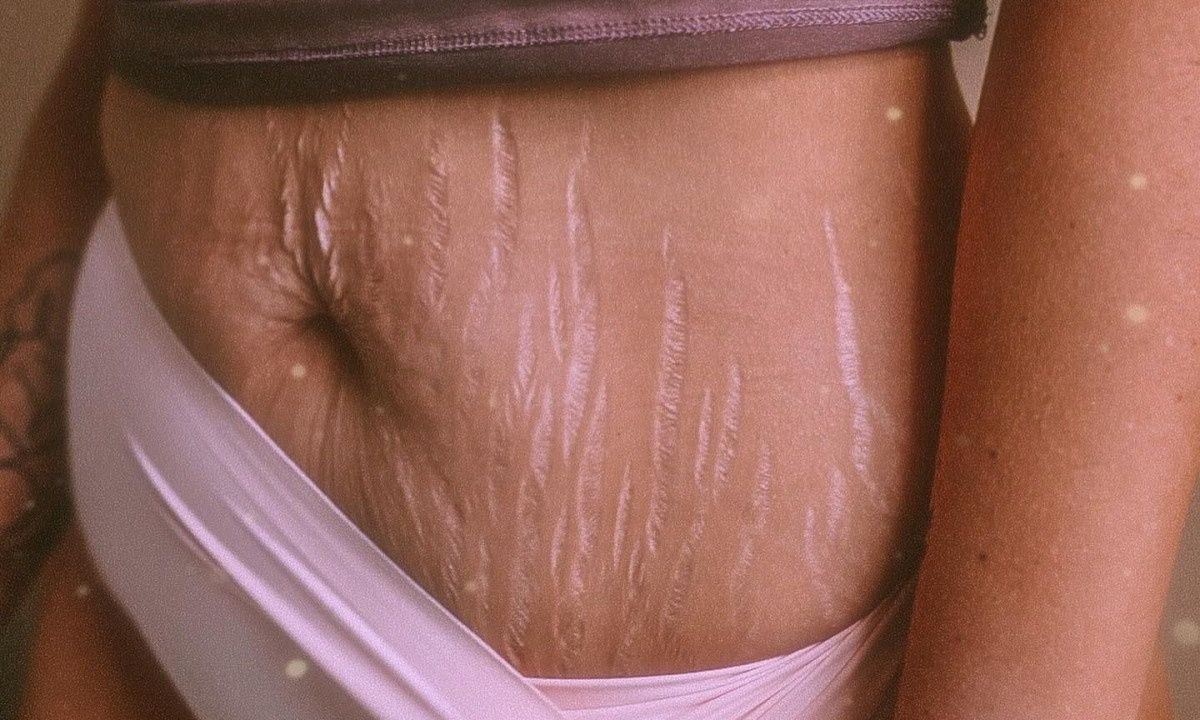 Οι ραγάδες της εγκυμοσύνης είναι σημάδια της ζωής