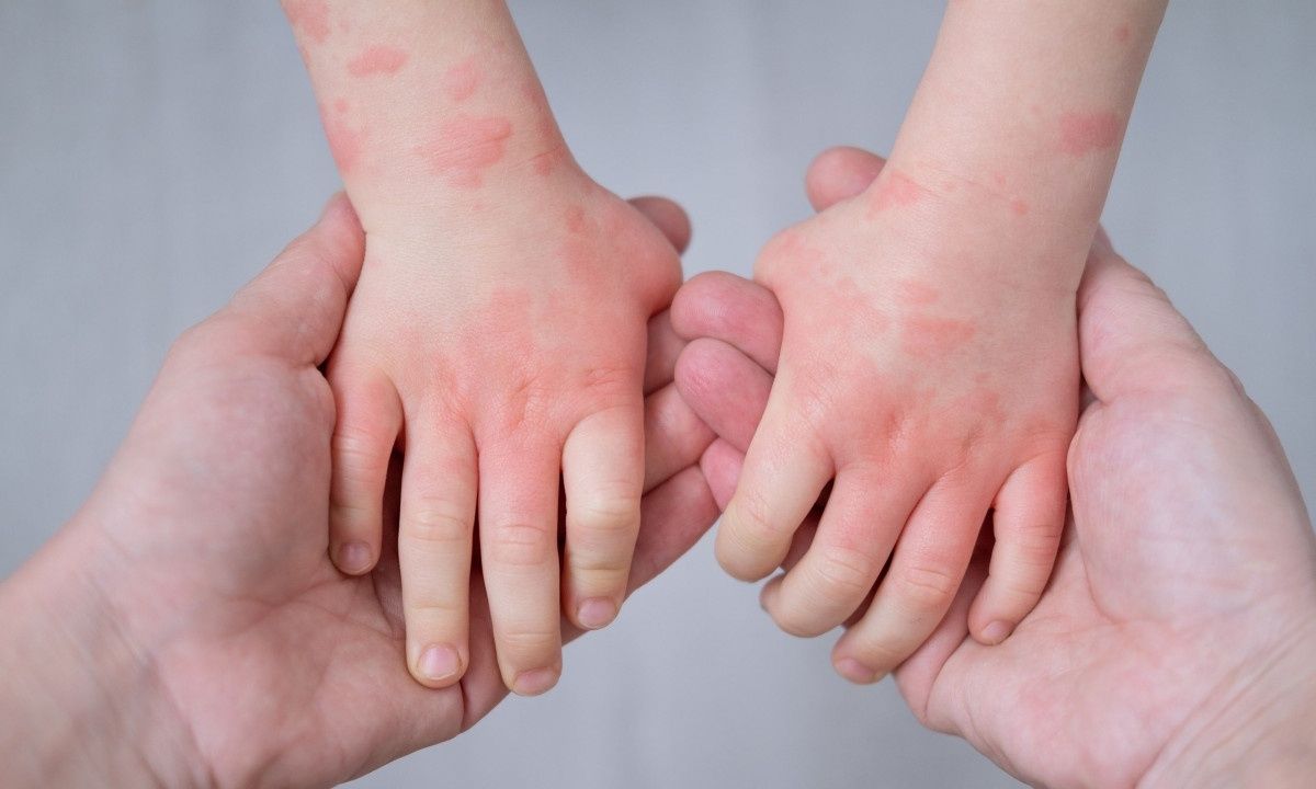 Ποια μωρά κινδυνεύουν να αναπτύξουν έκζεμα και άσθμα;