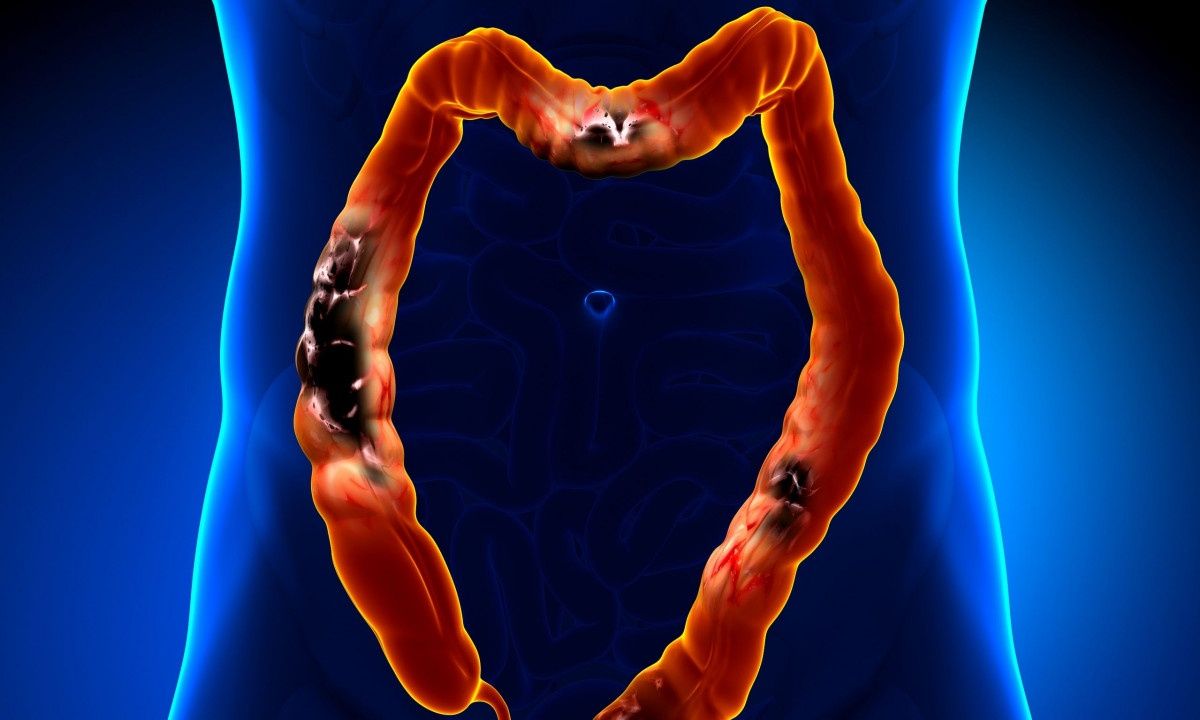 Καρκίνος παχέος εντέρου: Το πρώτο εμβόλιο είναι γεγονός