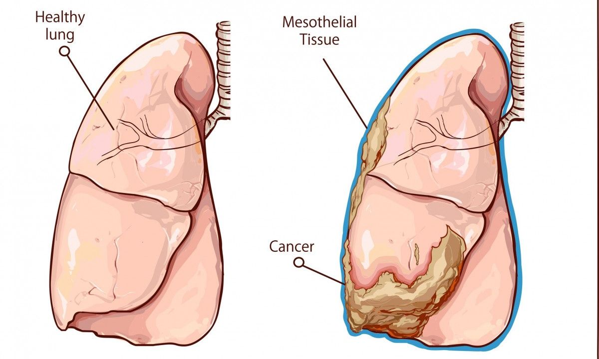 Μεσοθηλίωμα: Ο δύσκολος καρκίνος και η νέα θεραπεία