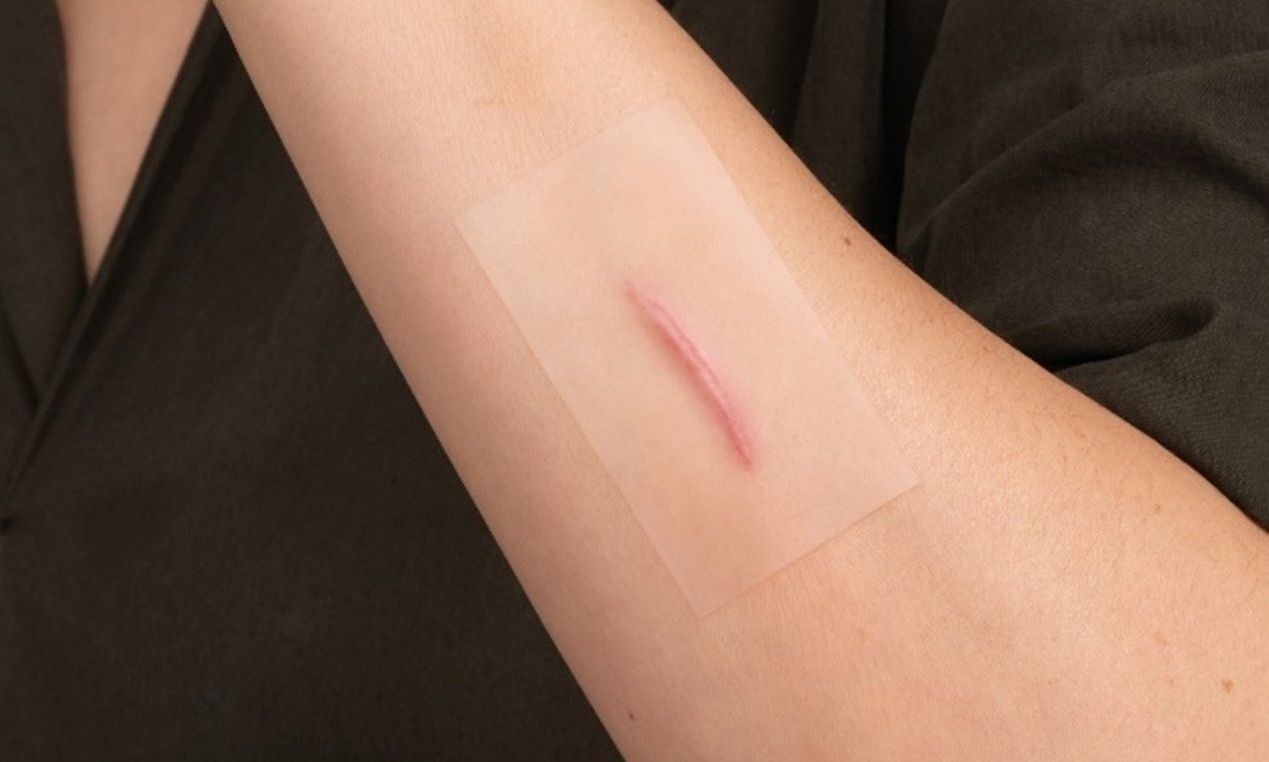 Η επιστήμη των ουλών: Η διαδικασία επούλωσης, η διαμόρφωση της ουλής και οι λύσεις