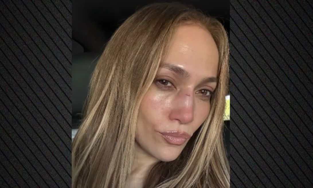 Τζένιφερ Λόπεζ: Εμφανίστηκε με τραύματα στο Instagram και προκάλεσε ανησυχία