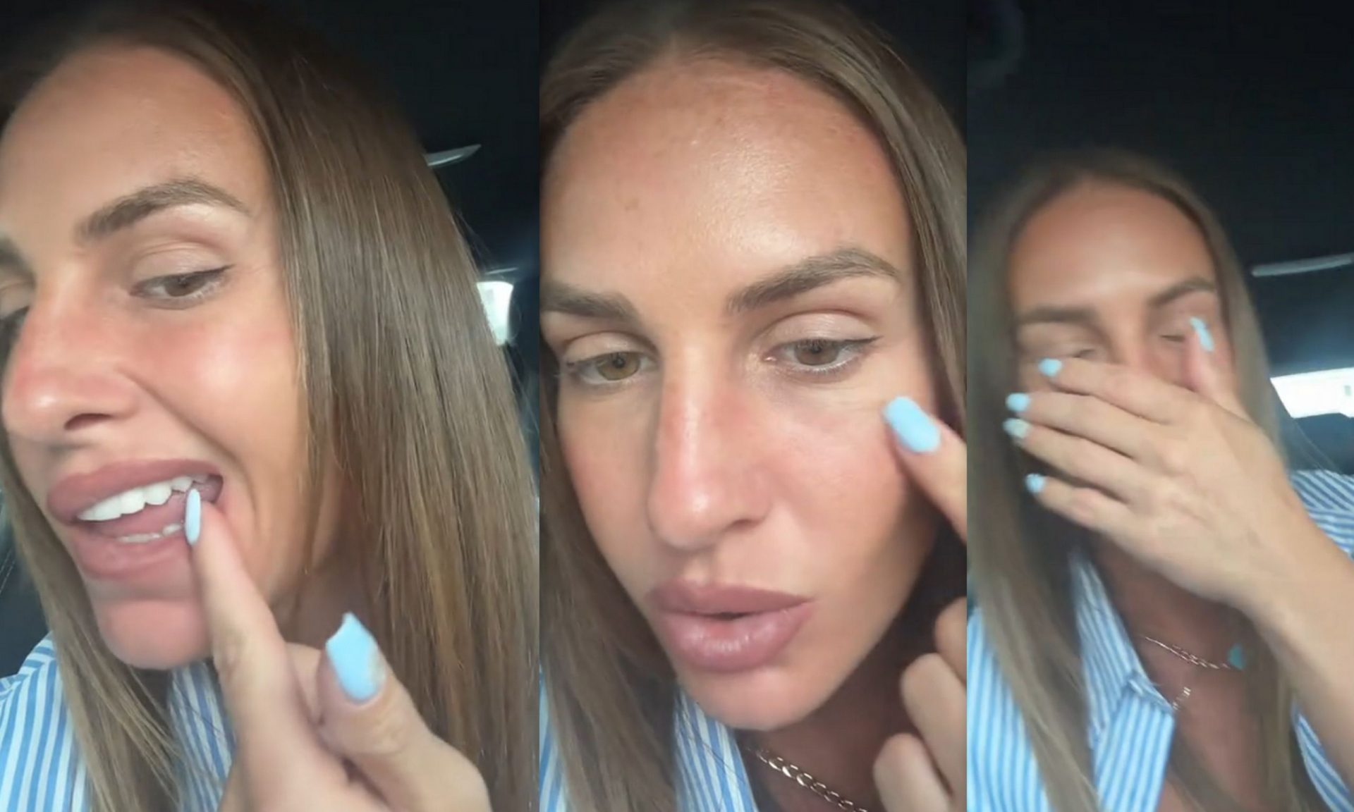 Ατύχημα για τη Δαλάκα: «Εκτός του ότι έχω σακατευτεί και έχω πρηστεί, έσπασα & δόντι»