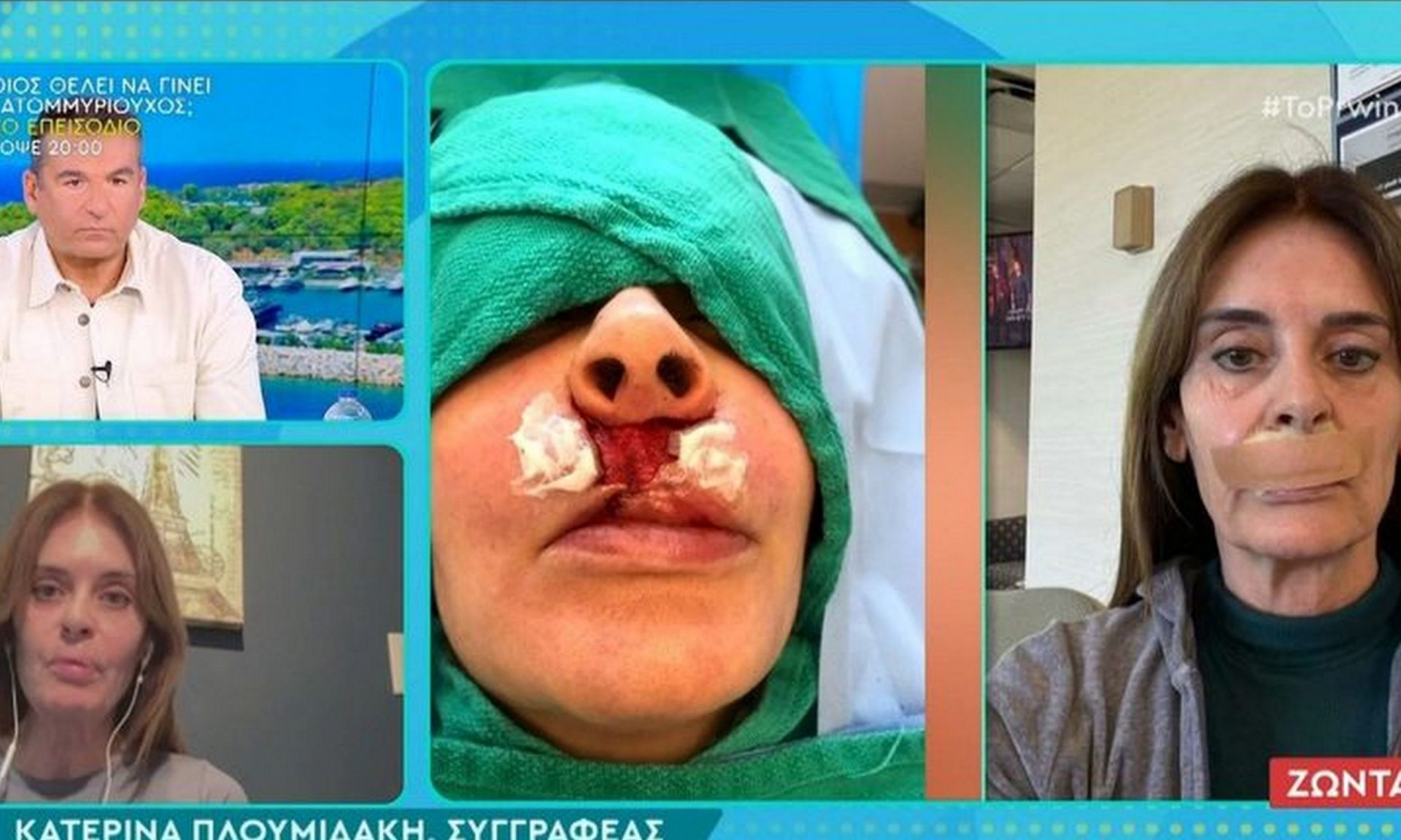 Σοκάρει η Πλουμιδάκη: Παίρνουν κάθε ενάμιση μήνα λίπος από τον γλουτό για να μου φτιάξουν τα χείλη