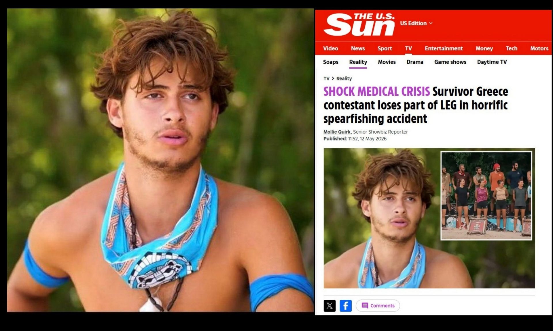 Survivor – Σταύρος Φλώρος: Η είδηση του τραυματισμού κάνει τον γύρο του κόσμου! Τα ξένα πρωτοσέλιδα