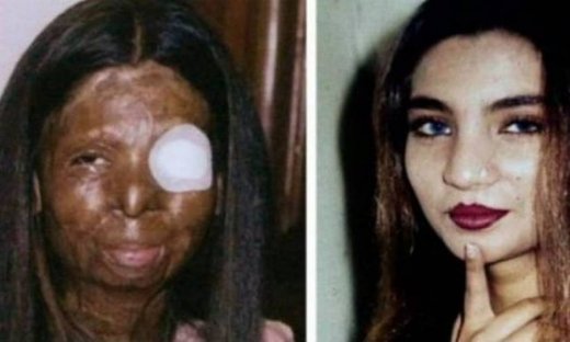 Αυτοκτόνησε μετά από 38 διορθωτικές επεμβάσεις στο πρόσωπο