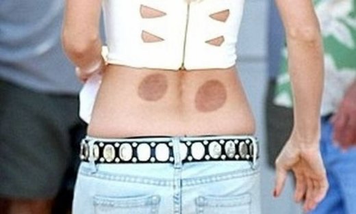 Ηθοποιός κυκλοφορεί δημόσια με σημάδια από… βεντούζες! (φωτό)