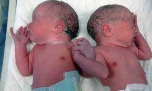Συγκλονιστική φωτογραφία: Δίδυμα γεννήθηκαν πιασμένα χέρι – χέρι!
