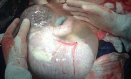 Η συγκλονιστική φωτογραφία μωρού μέσα στον αμνιακό σάκο που έφερε στον κόσμο Έλληνας γιατρός, κάνει τον γύρο του κόσμου!