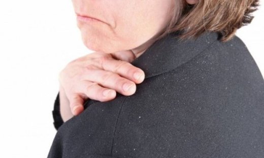 Σμηγματορροΐκή δερματίτιδα: Πώς θα απαλλαχθείτε από τις άσπρες νιφάδες