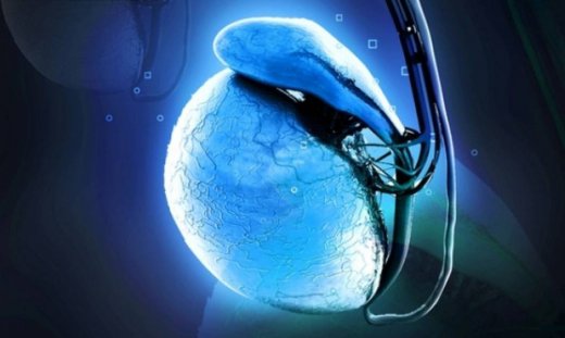 Υδροκήλη: Τα συμπτώματα συσσώρευσης υγρού στους όρχεις