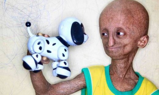 Το ηλικιωμένο… αγοράκι που γερνά οκτώ φορές γρηγορότερα (photos)