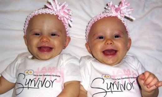 Τι είναι το σύνδρομο υποκλοπής διδύμων