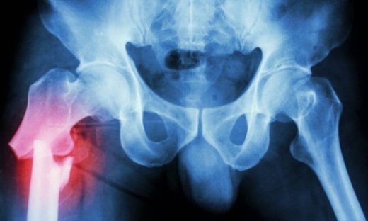 Tροχαντηρίτιδα: Τι είναι, πού οφείλεται, πώς αντιμετωπίζεται