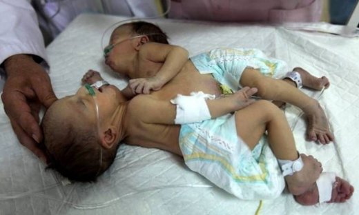 Xώρισαν σιαμαία 8 ημερών