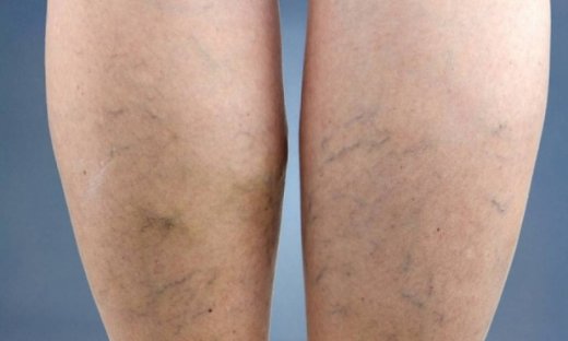 Φλεβική θρόμβωση: Παράγοντες κινδύνου και πρόληψη